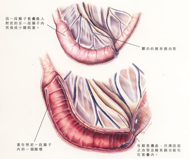 肠套叠是怎么引起的图片