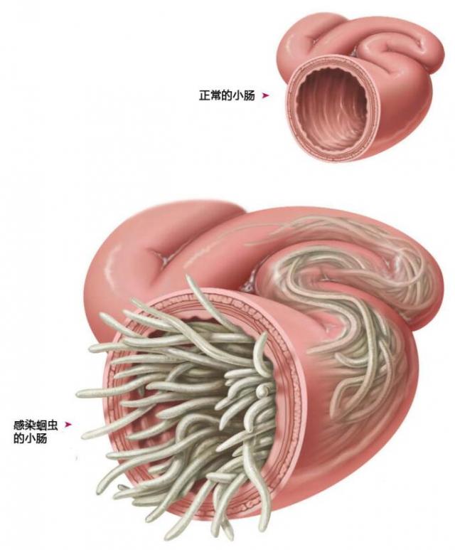 蛔虫感染示意图