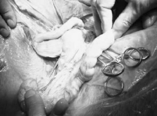 图6：黑背手术暴露的蓄脓子宫