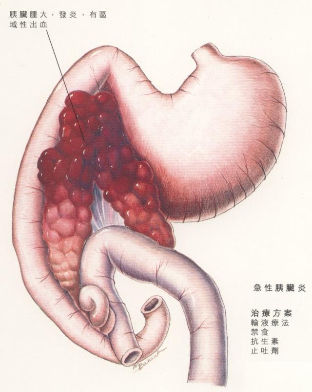 急性胰腺炎病理生理图图片