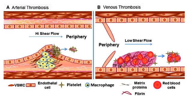 动脉血栓和静脉血栓的对比