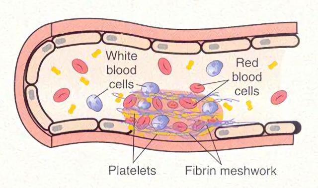 血栓形成示意图