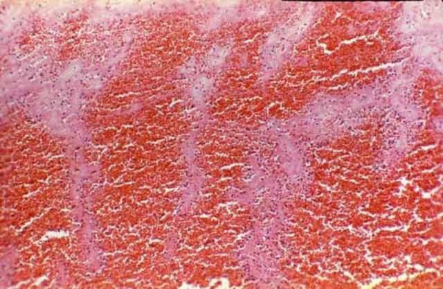 血管内混合血栓图片图片