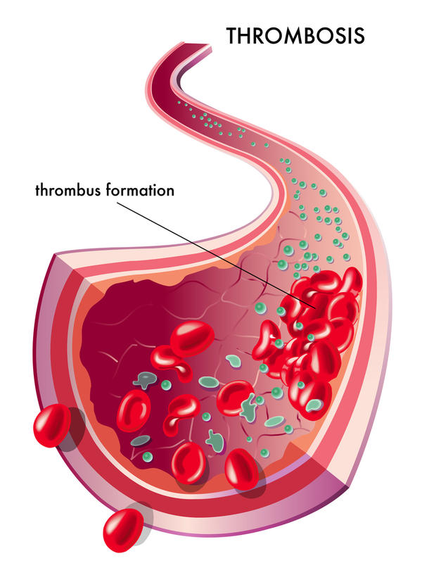 thrombosis