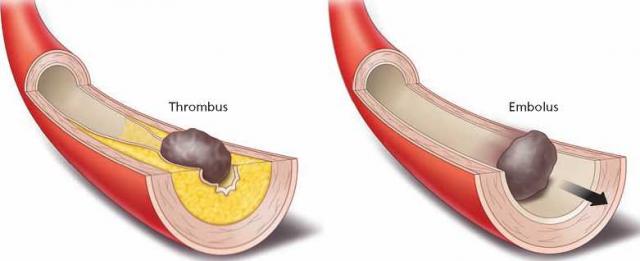 血栓和血栓性栓子示意图