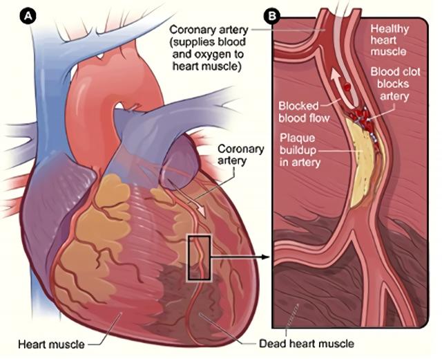 冠状动脉缺血性心肌病