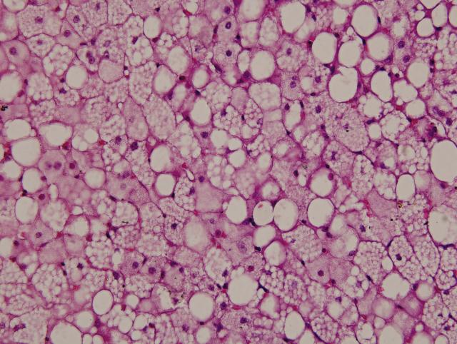肝脂肪变性切片图图片