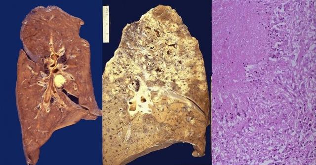 干酪样坏死（肺结核）