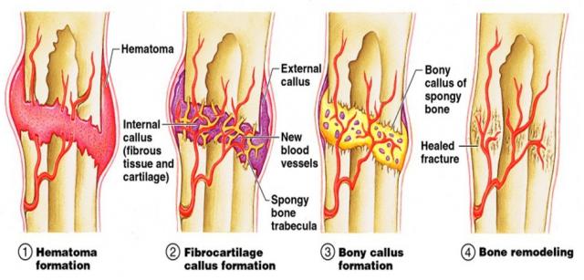 骨折愈合过程
