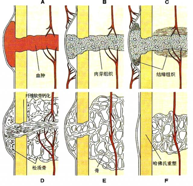 骨折愈合的过程
