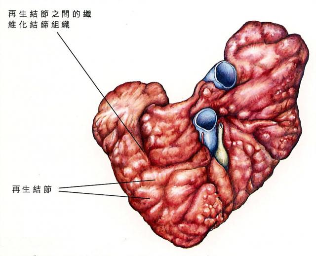 慢性肝炎后期肝硬化