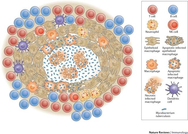 感染性肉芽肿（结核灶）结构模式图