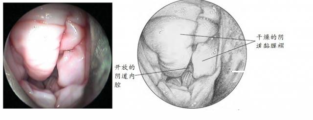 阴道的内窥镜检查