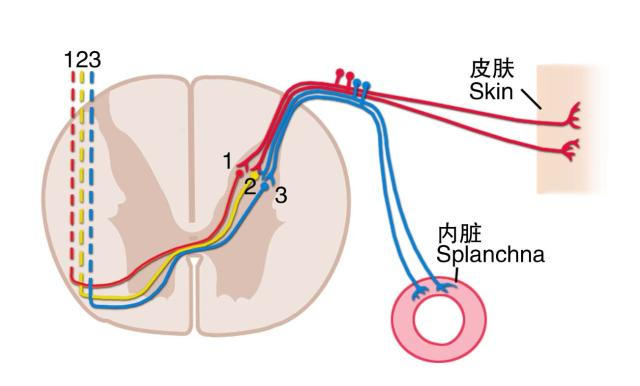 牵涉痛产生机制示意图