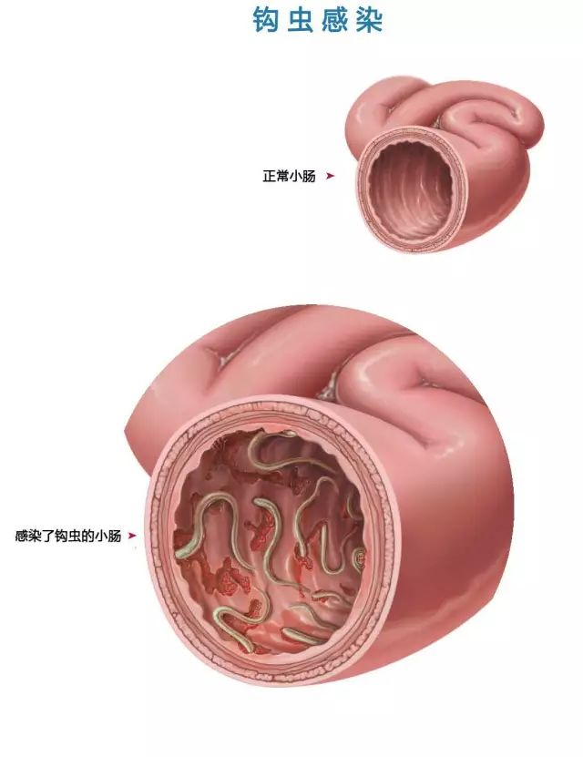 感染了钩虫的小肠