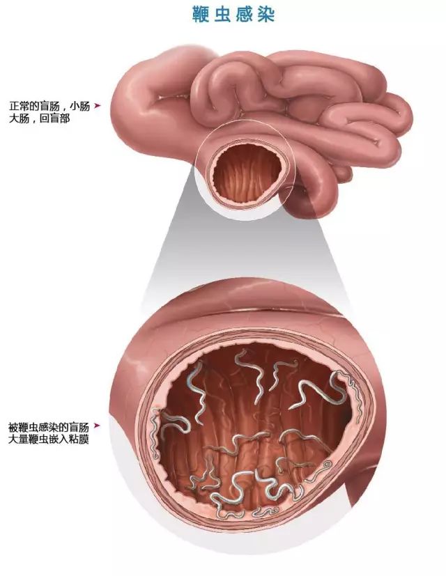 感染了鞭虫的犬的盲肠