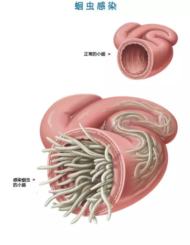 感染了蛔虫的小肠