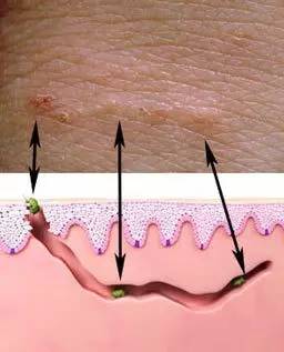 疥螨挖掘隧道