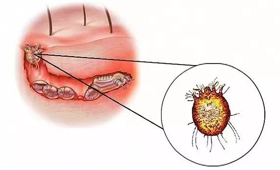 疥螨虫多大图片