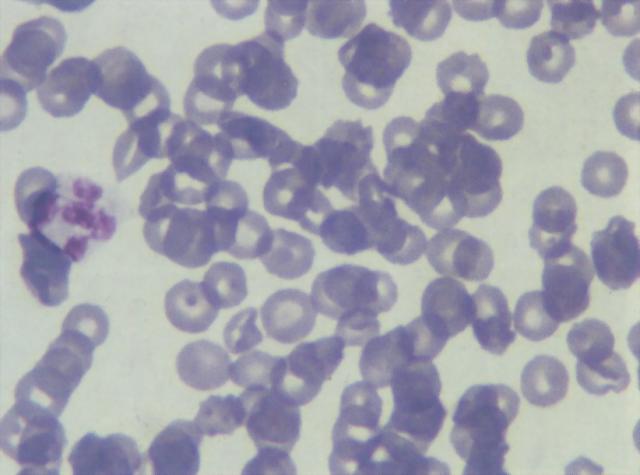 推片不良的血涂片：细胞叠加