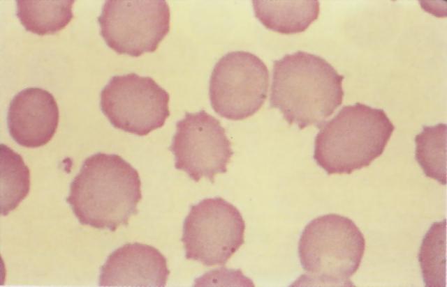 犬轻度红细胞皱缩（棘形红细胞）