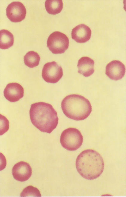 红细胞内嗜碱性颗粒