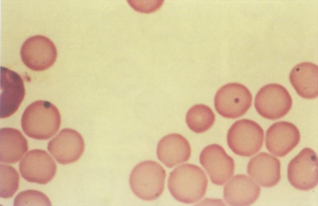 豪-若氏小体、高血色素红细胞