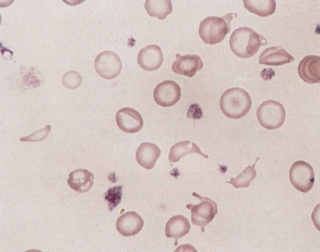 异形红细胞、低色素血症、小红细胞症