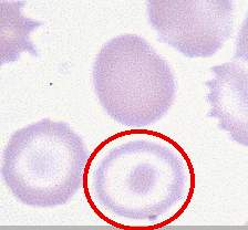 靶形红细胞（人）
