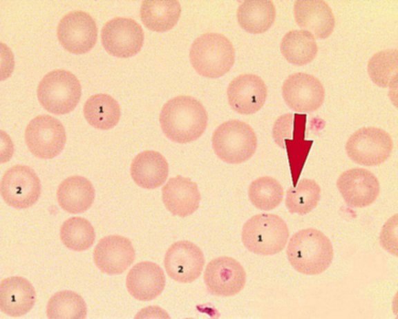 高铁红细胞和靶形红细胞