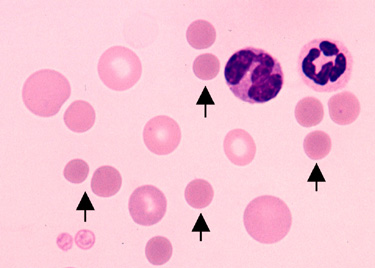 球形红细胞(Spherocytes)