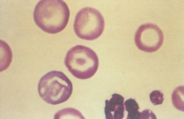 靶形红细胞