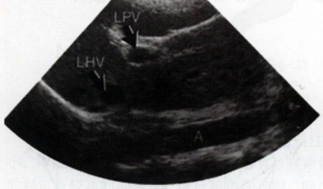 犬肝胆第4矢状面声像图：示主动脉(A)及左肝静脉(LHV)，门静脉左支(LPV)