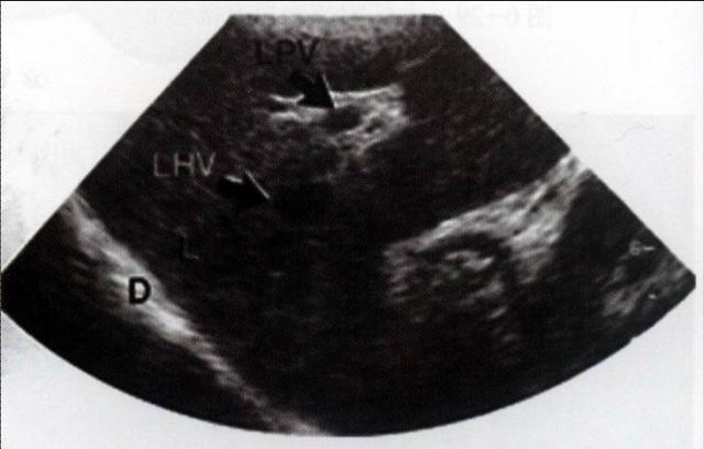 犬肝胆第5矢状面声像图：膈肌(D)上方肝左叶(L)内可显示LHV和LPV