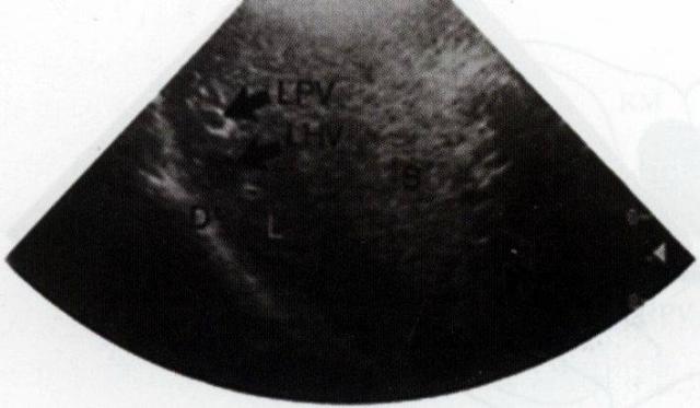 犬肝胆第6矢状面声像图：肝左外侧叶(L)内可显示LPV和LHV，邻近的脾头(S)回声比肝实质回声稍强
