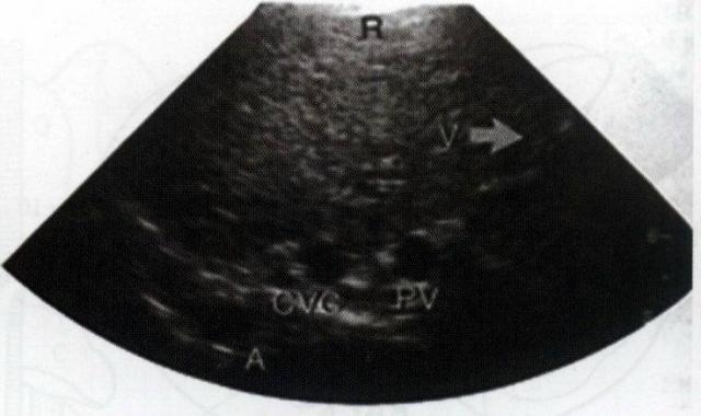 犬肝胆第7横切面声像图：以肝叶作为透声窗可显示A、CVC、PV。R表示右侧腹壁，V表示腹侧