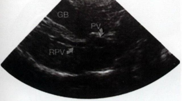 犬肝胆第8横切面声像图：该水平位可显示RPV从PV分出，并可见部分GB