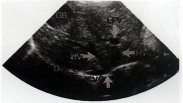 犬肝胆第9横切面声像图：可清楚显现LPV及HV进入CVC，并可见D和部分GB