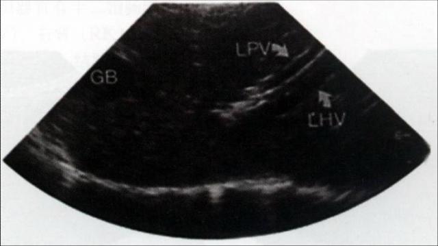 犬肝胆第10横切面声像图：该水平位显示LHV和LPV平行，并可见部分GB