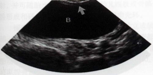 犬膀胱纵切面声像图：膀胱（B）呈无回声液性暗区，但腹侧膀胱壁（箭头所指）离探头太近而显示不清