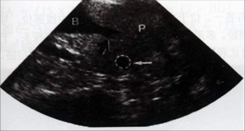 公犬近段尿道纵切面声像图：通常只能显示膀胱（B）尾端延伸至前列腺（P）部分的尿道（黑色箭头），偶尔可见盆腔部尿道，前列腺内有一小囊肿（白色箭头）
