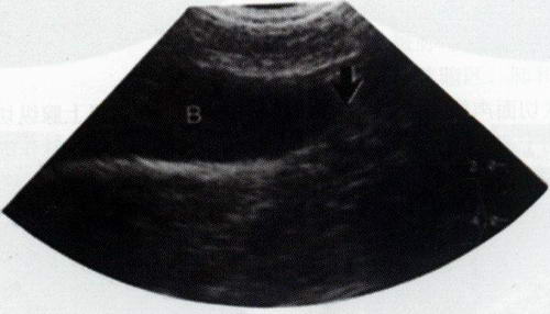 母犬近段尿道纵切面声像图：膀胱（B）尾部可显示部分尿道