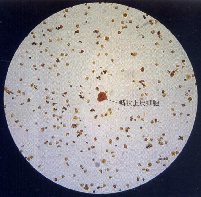 犬尿沉渣中的红细胞和上皮细胞