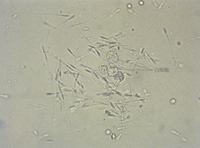 犬尿沉渣中的精子和白细胞