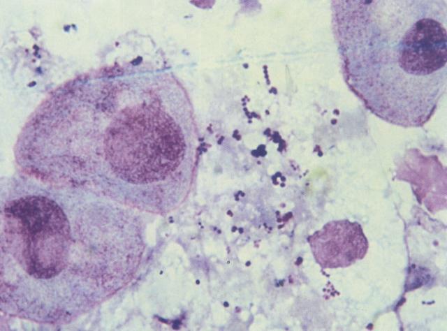 尿沉渣中的小圆上皮细胞和球菌