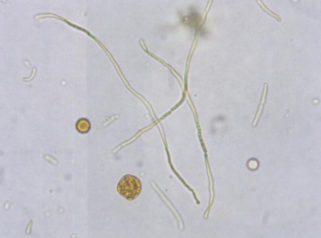 猫尿沉渣中的小脂滴、红细胞和白色念珠菌菌丝