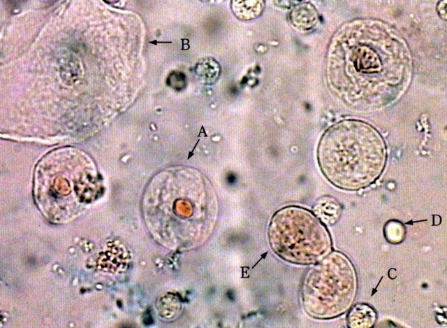尿沉渣中的几种细胞成分