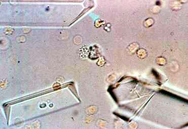 尿酸铵结晶图图片