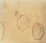 尿沉渣中的胱氨酸结晶(未染色)