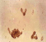 尿沉渣中的尿酸铵结晶(未染色)